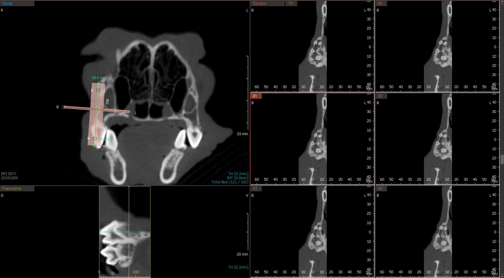 치근 CT