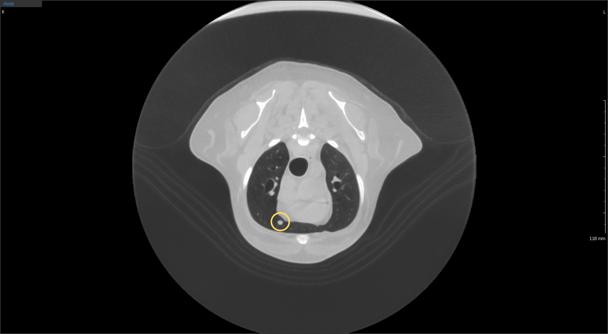 폐결절 CT