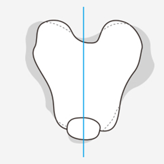 슬개골 탈구 단계 이미지 1