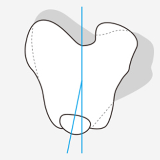슬개골 탈구 단계 이미지 2