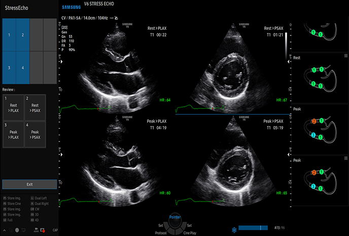심장 초음파 예시 이미지 14