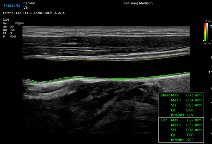 심장 초음파 예시 이미지 15