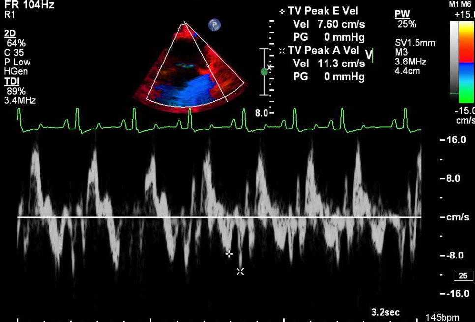 폐성고혈압으로 인한 우심부전 사례